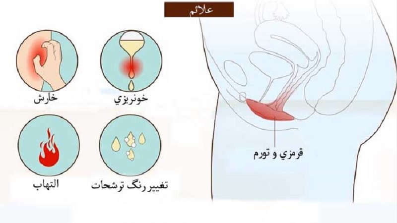 درمان عفونت قارچی واژن