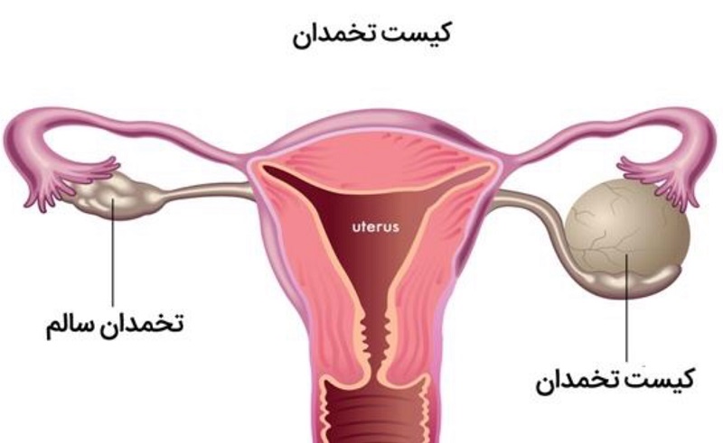 درمان کیست تخمدان با تغذیه سالم