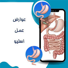 عوارض و خطررات اسلیو معده