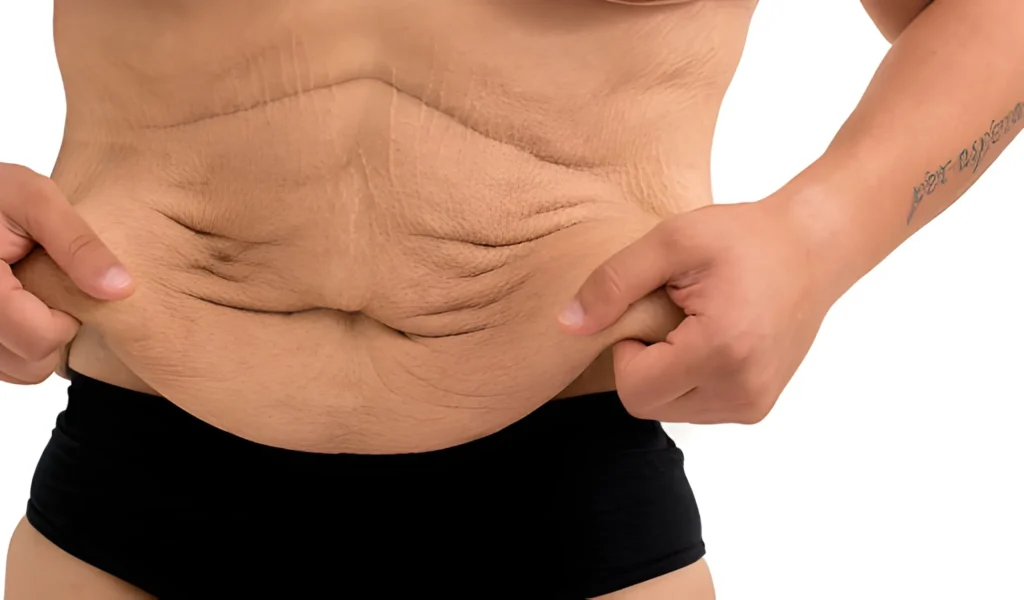 دلایل افتادگی پوست بعد از لاغری